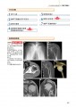 人工关节置换术并发症的处理